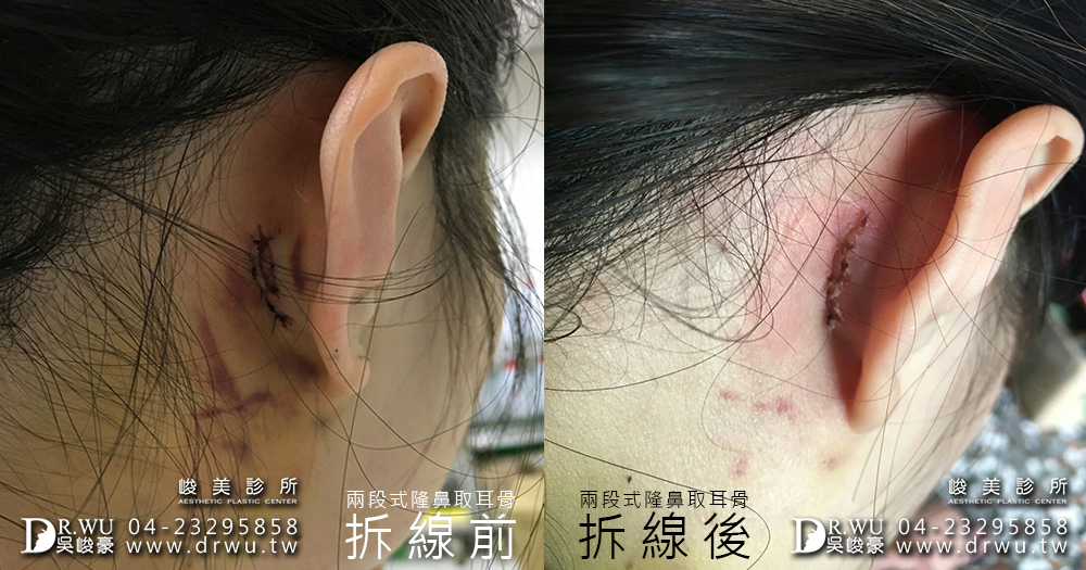 兩段式隆鼻取耳骨|精緻型美鼻很簡單|雨兒女神見證