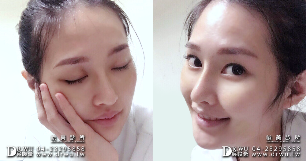兩段式隆鼻取耳骨|精緻型美鼻很簡單|雨兒女神見證