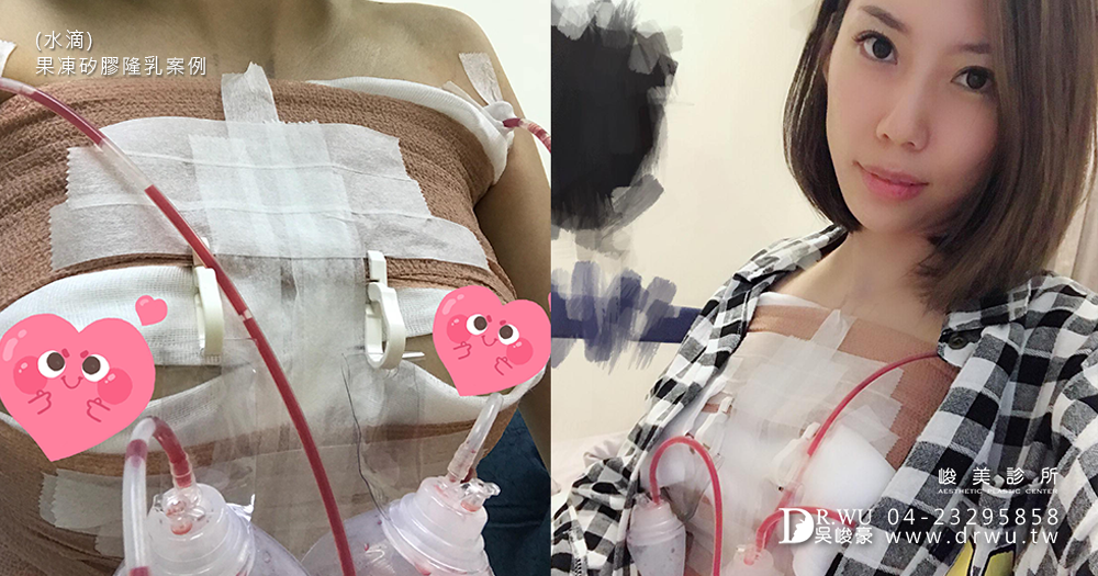隆乳後悔嗎?一點也不!只後悔沒早點做|水滴|果凍矽膠隆乳|峻美診所