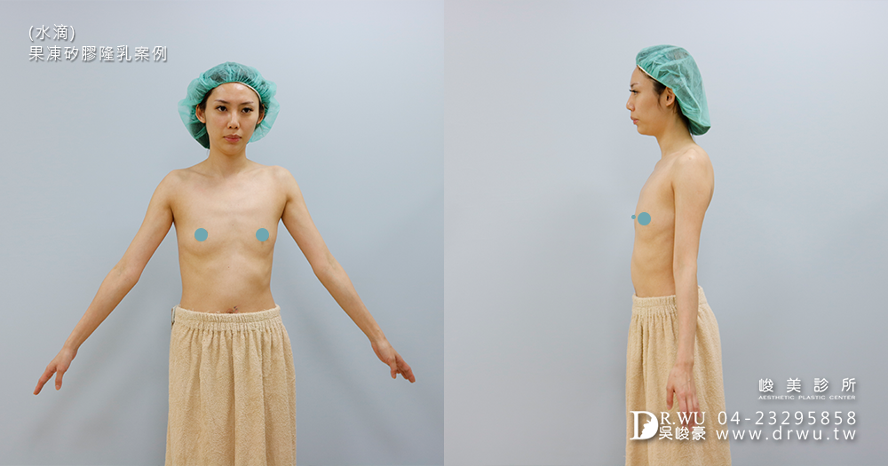 隆乳後悔嗎?一點也不!只後悔沒早點做|水滴|果凍矽膠隆乳|峻美診所