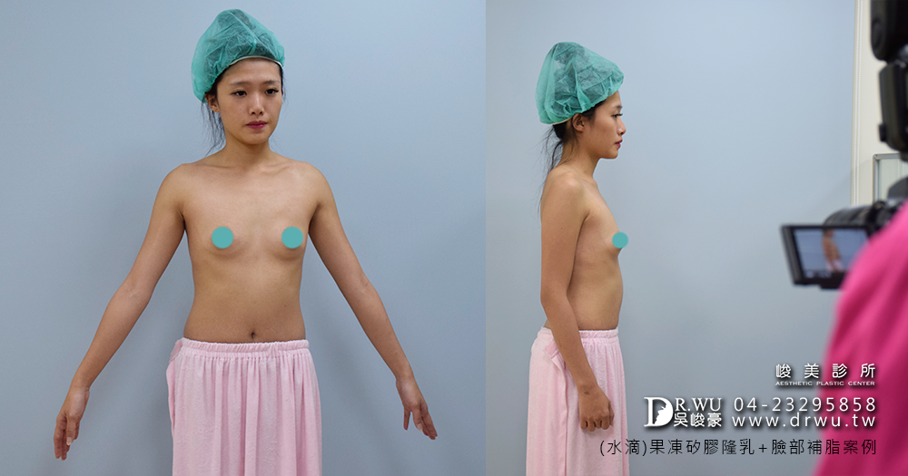 【隆乳】隆乳經驗+自體脂肪補臉分享=超級滿意|女神見證|峻美診所