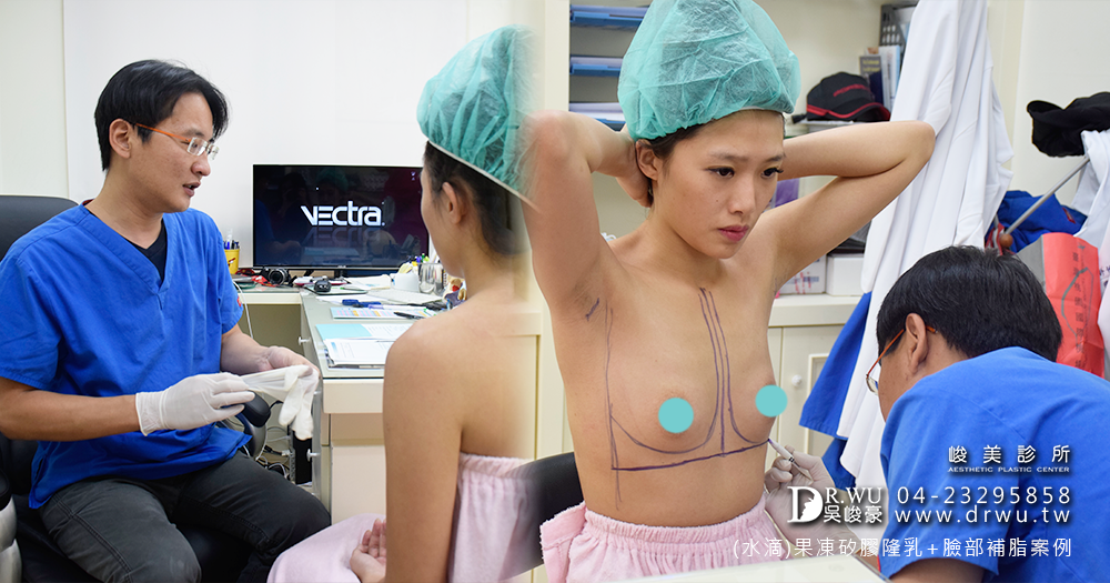 【隆乳】隆乳經驗+自體脂肪補臉分享=超級滿意|女神見證|峻美診所